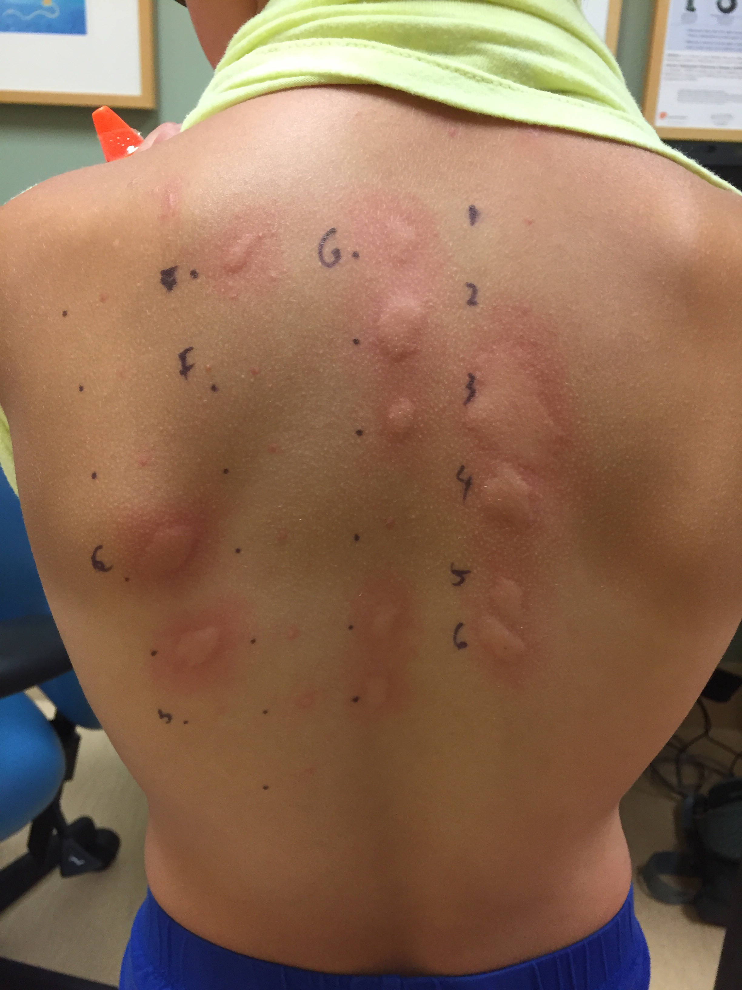 Skin Scratch Tests And MCAS The Walking Allergy